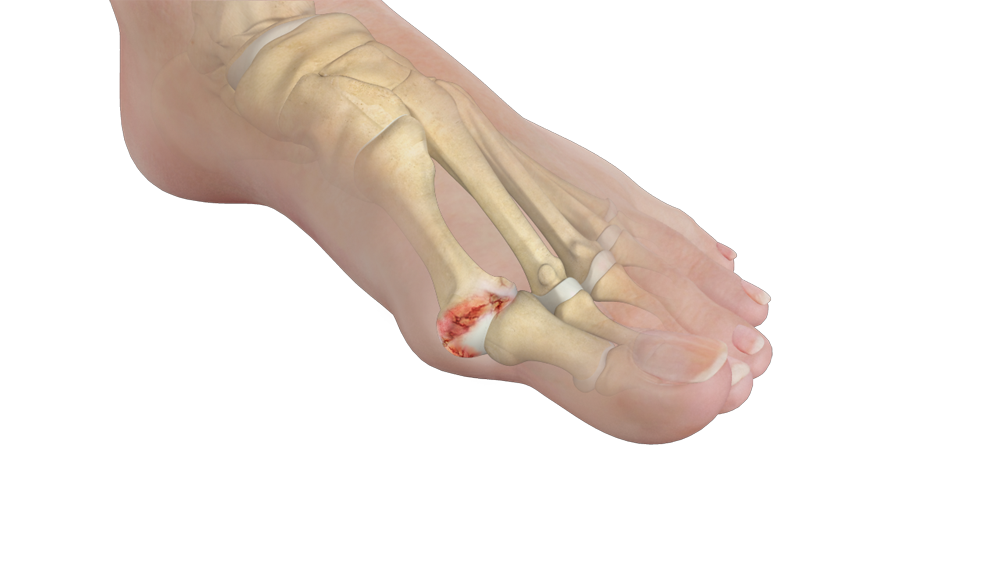 Stiff Big Toe images
